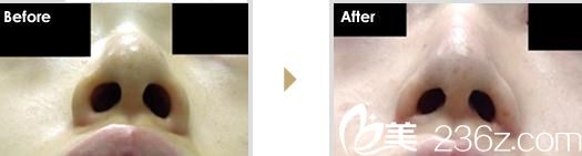 小鼻縮小術(shù)（外側(cè)法）1.jpg 鼻翼縮小術(shù)