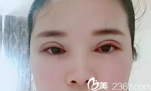做完雙眼皮開(kāi)眼角3天恢復(fù)照
