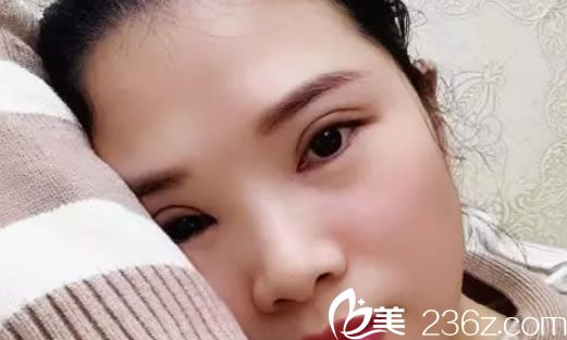 溫嶺維多利亞雙眼皮<span style=