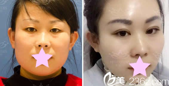 太原美媛薈整形雙12優(yōu)惠價格表來襲無痕祛眼袋低至1680元起