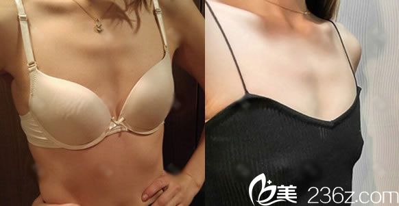 做假體隆胸手術(shù)前的平胸照片 做假體隆胸手術(shù)前的平胸照片