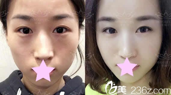 太原美媛薈整形自體脂肪全臉填充前后對比圖 太原美媛薈整形自體脂肪全臉填充前后對比圖