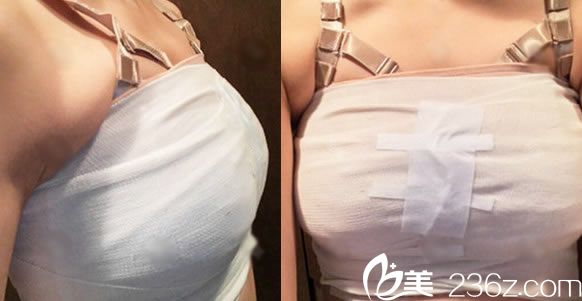 做完假體隆胸10天恢復(fù)照 做完假體隆胸10天恢復(fù)照