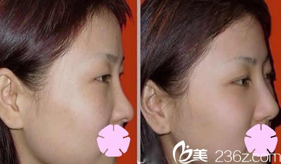 太原美媛薈整形鼻綜合術(shù)前術(shù)后對比圖 太原美媛薈整形鼻綜合術(shù)前術(shù)后對比圖