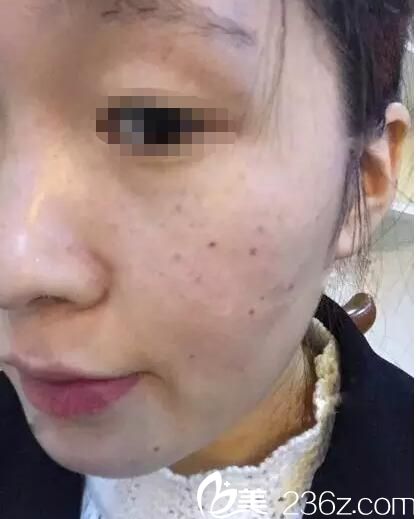 術(shù)前雀斑明顯 術(shù)前雀斑明顯
