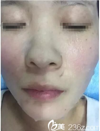 剛做完激光祛斑術(shù)后敷面膜 剛做完激光祛斑術(shù)后敷面膜