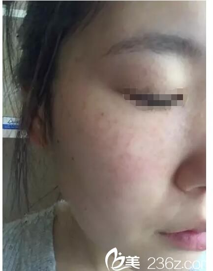 術(shù)后4天臉上開始結(jié)痂皮 術(shù)后4天臉上開始結(jié)痂皮