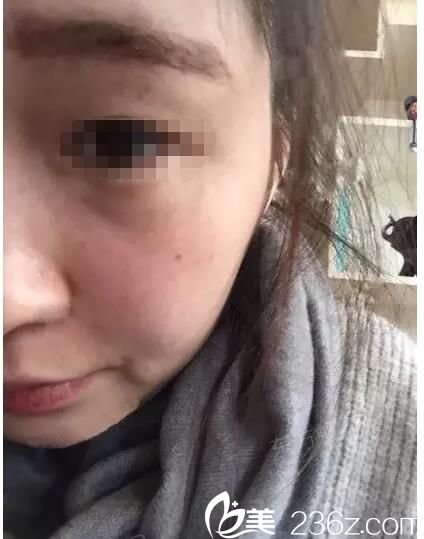 術(shù)后一周臉上斑點恢復 術(shù)后一周臉上斑點恢復