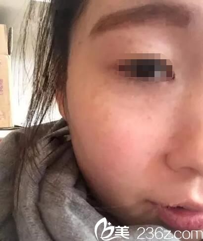 術(shù)后20天斑點淡化 術(shù)后20天斑點淡化