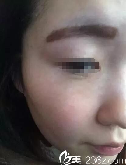 皮秒祛斑和大Q祛斑一樣嗎?看遺傳麻子臉在泰州華美做大Q祛雀斑術(shù)后無(wú)后遺癥效果還不錯(cuò)