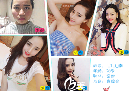 昆明伊美萊整形周誠醫(yī)生隆鼻對比圖