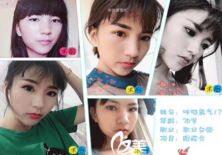 我在美伊萊整形雙眼皮前后效果圖