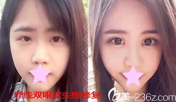 太原時(shí)光整形優(yōu)惠活動開始啦激光祛斑僅需999元附雙眼皮失敗修復(fù)案例圖