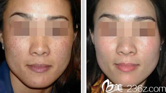 太原時(shí)光整形激光祛斑20天效果圖 太原時(shí)光整形激光祛斑20天效果圖