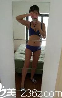 術(shù)后18天胸部變大腿部變細(xì) 術(shù)后18天胸部變大腿部變細(xì)