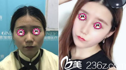 北京壹加壹耳軟骨復(fù)合隆鼻案例