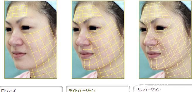 金線美容術(shù) 金線美容術(shù)