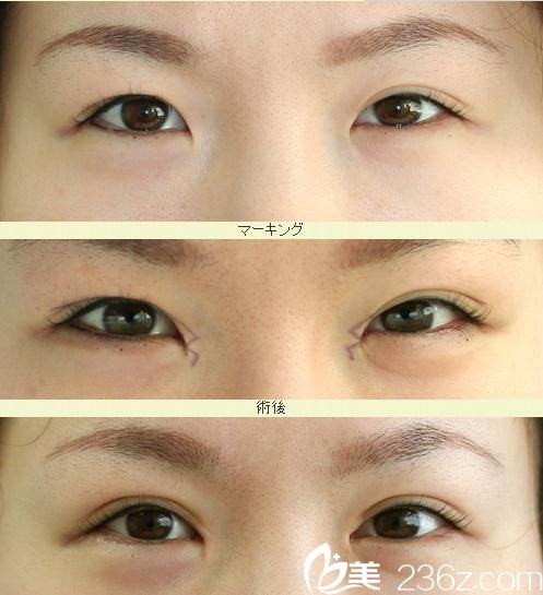 埋設(shè)法雙眼皮 埋設(shè)法雙眼皮