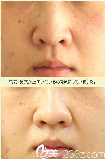 鼻翼縮小術(shù) 鼻翼縮小術(shù)