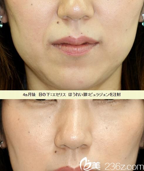 微整注射去法令紋 微整注射去法令紋