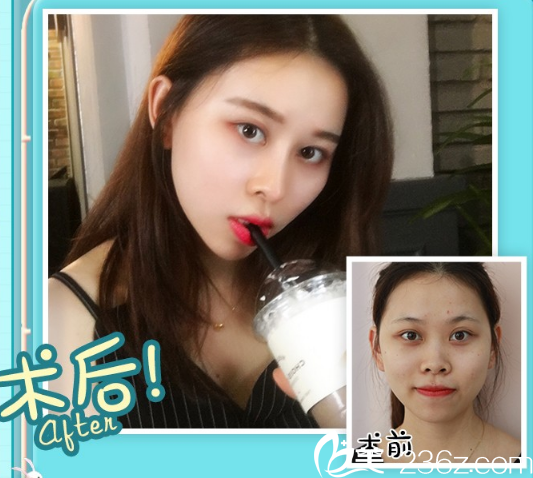 廣州美萊做鼻子怎么樣多少錢？李高峰/劉豪做鼻綜合隆鼻16800元起