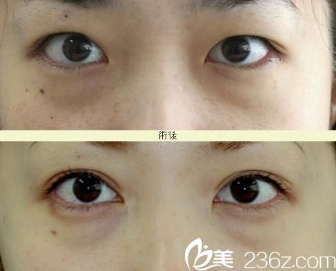 開眼角+埋線雙眼皮 開眼角+埋線雙眼皮