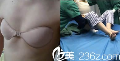 <!--<i data=20240703-sp></i>-->整形假體隆胸術前照 <!--<i data=20240703-sp></i>-->整形假體隆胸術前照