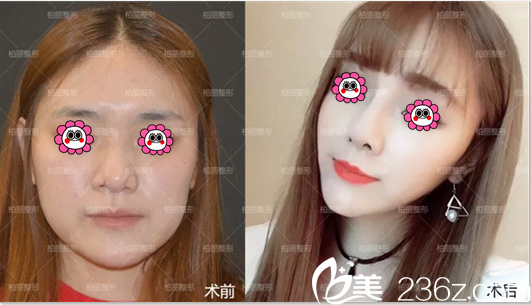 北京李勁良金字塔隆鼻多少錢(qián)？李勁良金字塔隆鼻48800元起