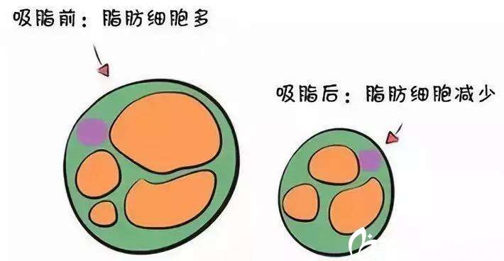 吸脂瘦身的原理 吸脂瘦身的原理