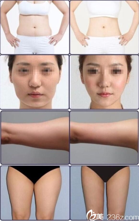 <!--<i data=20240703-sp></i>-->吸脂案例 <!--<i data=20240703-sp></i>-->吸脂案例