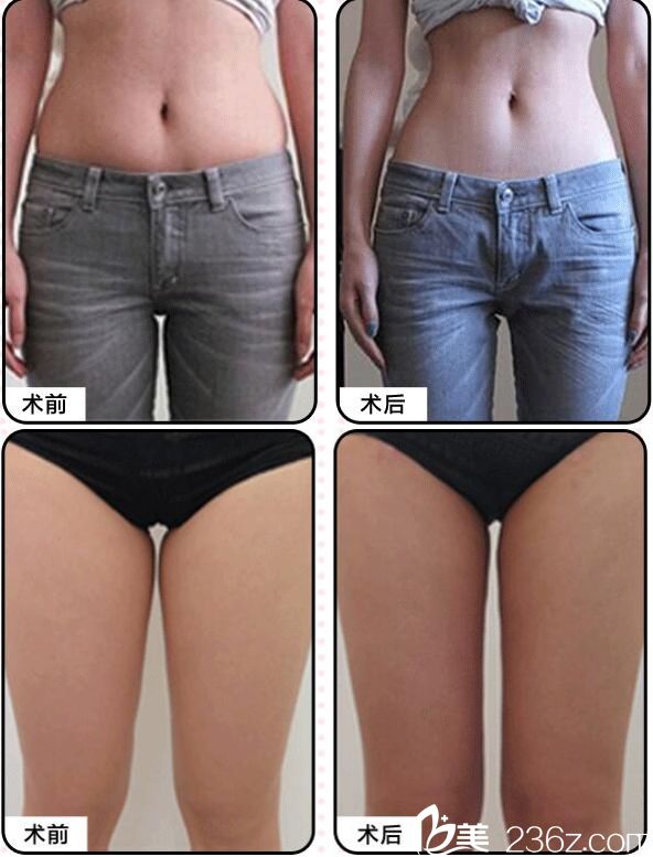 武漢美基元吸脂案例 武漢美基元吸脂案例
