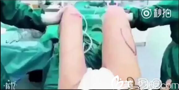 武漢壹加壹大腿吸脂術(shù)中即刻效果對(duì)比 武漢壹加壹大腿吸脂術(shù)中即刻效果對(duì)比