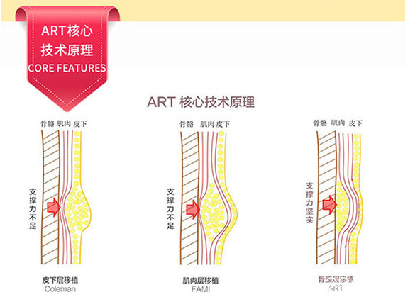 北京上上相脂肪填充技術(shù)核心技術(shù)示意圖