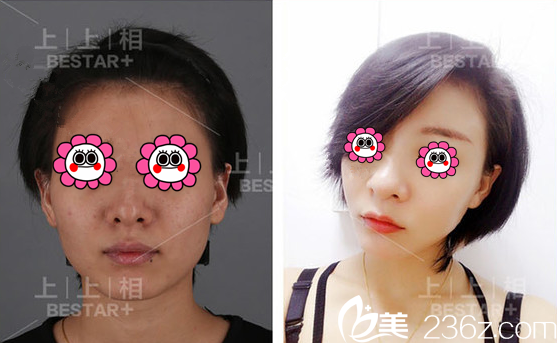 北京上上相黃罡自體脂肪面部填充案例