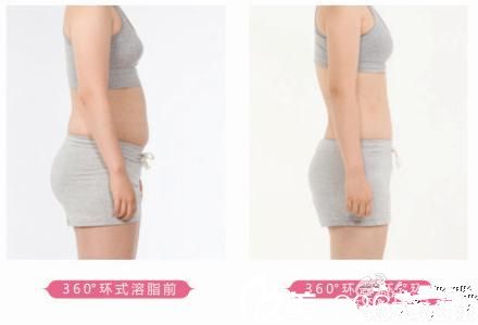 <!--<i data=20240703-sp></i>-->吸脂案例 <!--<i data=20240703-sp></i>-->吸脂案例