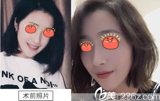 伊婉與艾莉薇哪個(gè)隆鼻好 伊婉與艾莉薇哪個(gè)隆鼻好