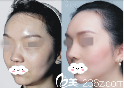 衡陽(yáng)雅美鼻綜合真人案例