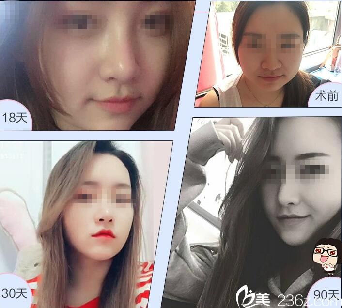 武漢媄妲面部吸脂案例 武漢媄妲面部吸脂案例