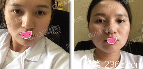 手術(shù)前臉部輪廓比較粗獷 手術(shù)前臉部輪廓比較粗獷