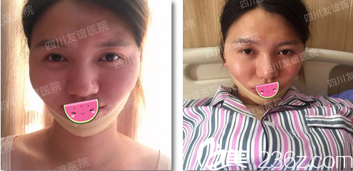 <!--<i data=20240703-sp></i>-->李繼華下頜角整形術(shù)后3天 <!--<i data=20240703-sp></i>-->李繼華下頜角整形術(shù)后3天