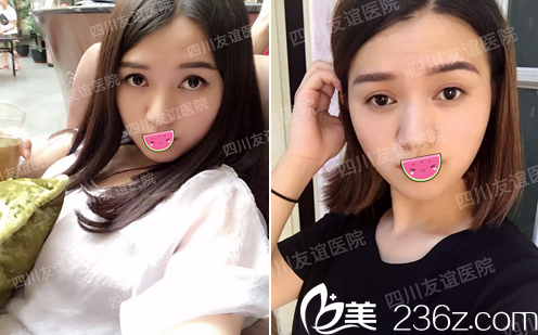 成都友誼醫(yī)院李繼華V-line改臉型術(shù)后一個月 成都友誼醫(yī)院李繼華V-line改臉型術(shù)后一個月