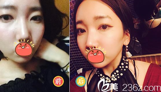 紹興藝美方倫磊全切雙眼皮案例