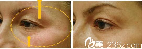 上眼瞼松弛提升 上眼瞼松弛提升