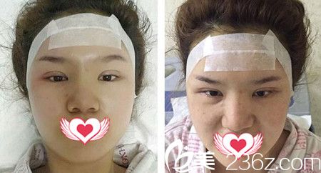 做自體脂肪填充額頭與太陽(yáng)穴術(shù)后天
