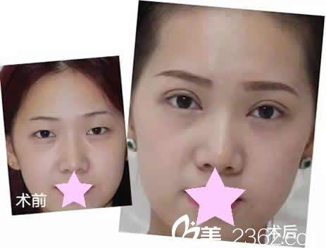 太原善美整形雙眼皮加開眼角前后對(duì)比圖