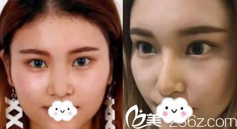 太原善美整形假體隆鼻案例效果