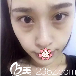 我的眼袋太明顯 我的眼袋太明顯