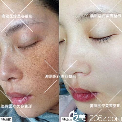 謝洪英醫(yī)師祛斑案例