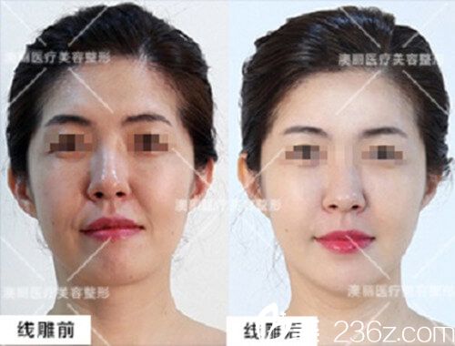 趙雙醫(yī)師線雕提升案例