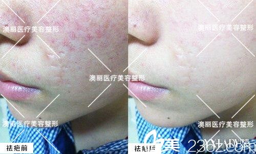 祛疤案例